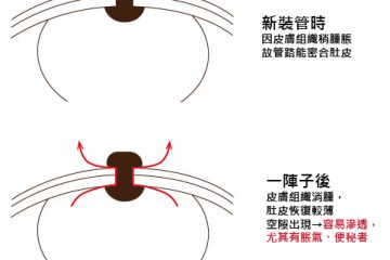 胃造廔管傷口照護