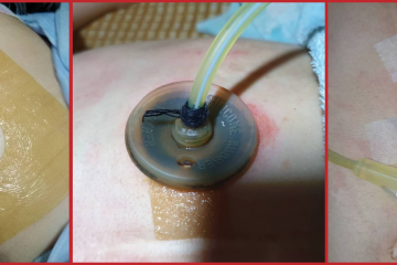 胃造廔管的護理