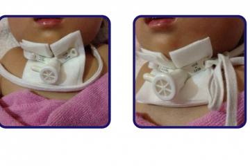 氣切繩綁法，與購買注意事項